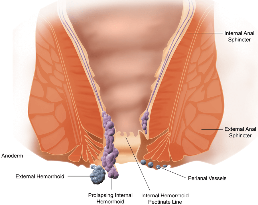Hemorrhoids development is accompanied by pain, itching and nodes loss